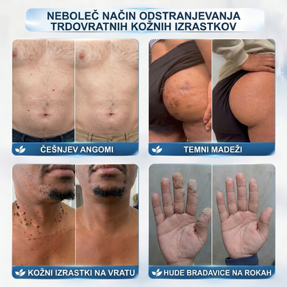 Uradna trgovina|✅️👩‍⚕️𝐇𝐈𝐒𝐊𝐈𝐍®7 dnevni odstranjevalec kožnih izrastkov in madežev(𝐫𝐨𝐥𝐥-𝐨𝐧 𝐚𝐩𝐥𝐢𝐤𝐚𝐭𝐨𝐫: 𝐛𝐫𝐞𝐳 𝐛𝐨𝐥𝐞č𝐢𝐧 𝐢𝐧 𝐛𝐫𝐚𝐳𝐠𝐨𝐭𝐢𝐧)🌳