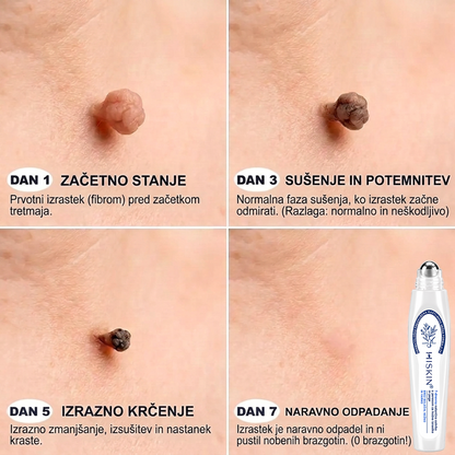 Uradna trgovina|✅️👩‍⚕️𝐇𝐈𝐒𝐊𝐈𝐍®7 dnevni odstranjevalec kožnih izrastkov in madežev(𝐫𝐨𝐥𝐥-𝐨𝐧 𝐚𝐩𝐥𝐢𝐤𝐚𝐭𝐨𝐫: 𝐛𝐫𝐞𝐳 𝐛𝐨𝐥𝐞č𝐢𝐧 𝐢𝐧 𝐛𝐫𝐚𝐳𝐠𝐨𝐭𝐢𝐧)🌳