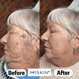 𝐇𝐈𝐒𝐊𝐈𝐍® 𝟕-𝐝𝐧𝐞𝐯𝐧𝐚 𝐤𝐫𝐞𝐦𝐚 𝐳𝐚 𝐤𝐨ž𝐧𝐞 𝐢𝐳𝐫𝐚𝐬𝐭𝐤𝐞 & 𝐩𝐢𝐠𝐦𝐞𝐧𝐭𝐧𝐞 𝐦𝐚𝐝𝐞ž𝐞 (𝐧𝐞𝐛𝐨𝐥𝐞č𝐚 𝐟𝐨𝐫𝐦𝐮𝐥𝐚 – 𝐛𝐫𝐞𝐳 𝐛𝐫𝐚𝐳𝐠𝐨𝐭𝐢𝐧) 🎉